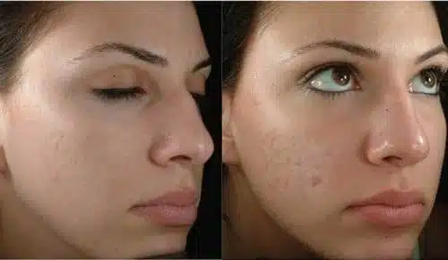 الليزر الكربوني للوجه قبل وبعد 1 | الموقع الالكتروني للدكتورة اسماء حجازي