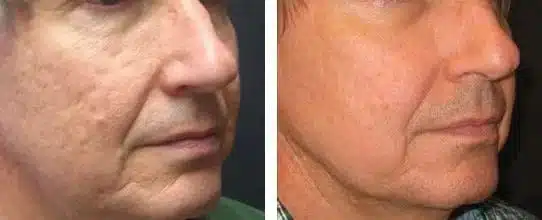 الليزر الكربوني للوجه قبل وبعد