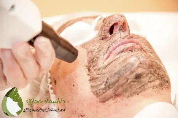 الليزر الكربوني للوجه قبل وبعد