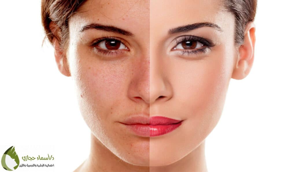 التقشير | الموقع الالكتروني للدكتورة اسماء حجازي تقشير الوجه