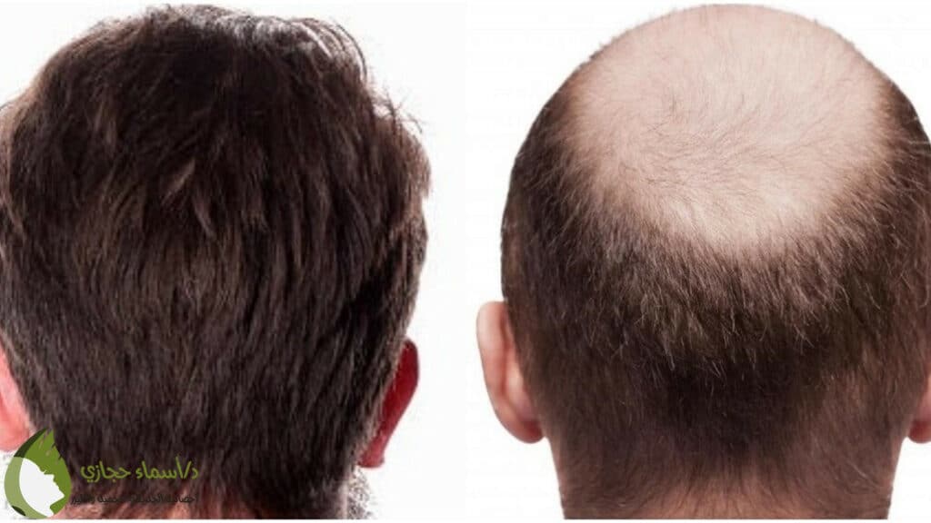 زراعة الشعر