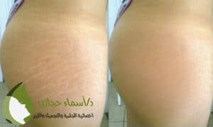 Before And After Stretch Marks | دكتور أسماء حجازى