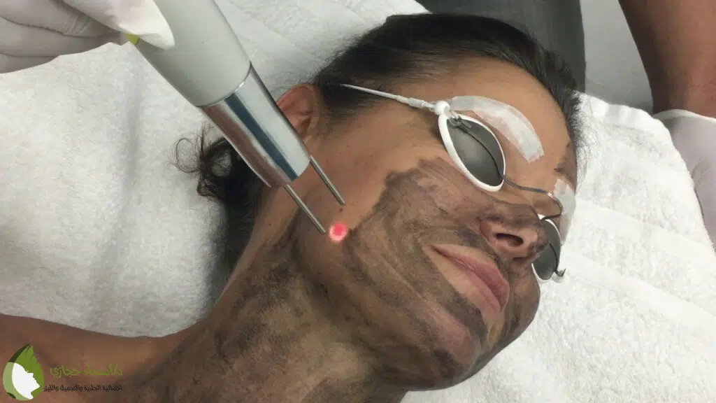 الليزر الكربوني للوجه