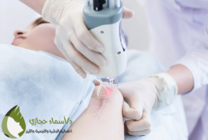 Scars Treatment 1 | دكتور أسماء حجازى
