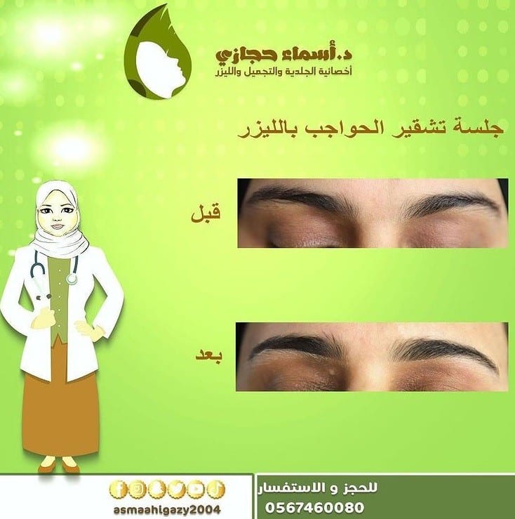 سارق بارد الكثير من الخير الجميل  الليزر الكربوني لتشقير شعر الوجه | دكتور أسماء حجازى
