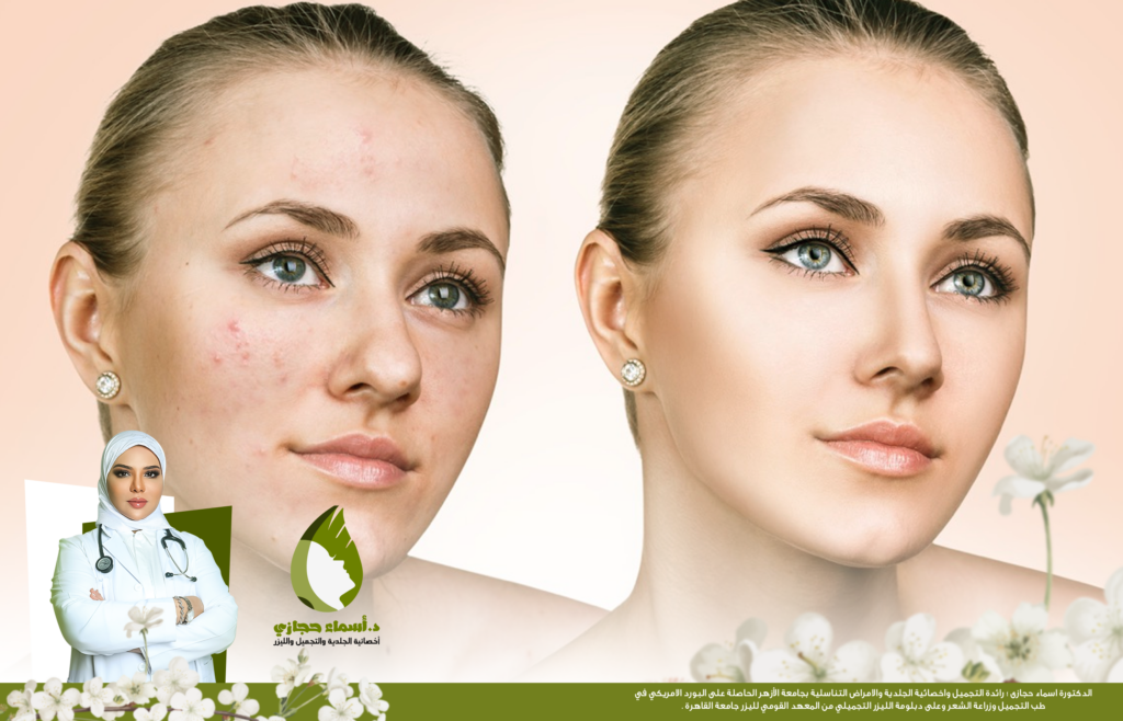 إبر النضارة