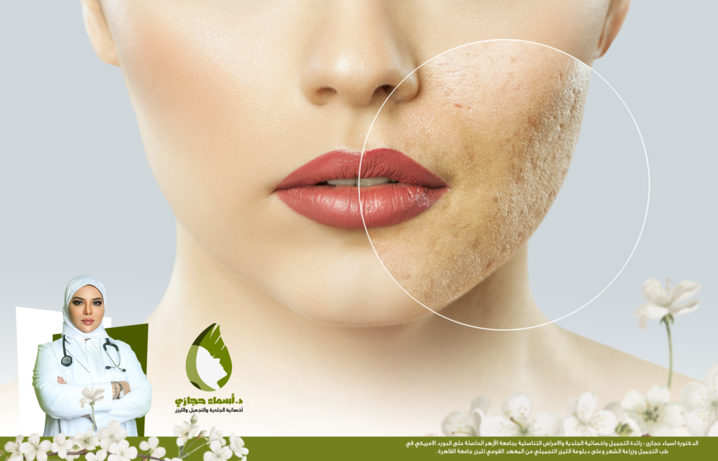 علاج اثار حب الشباب