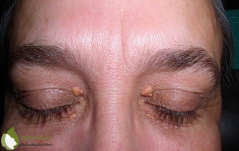 إزالة الزوائد الجلدية حول العين بالليزر