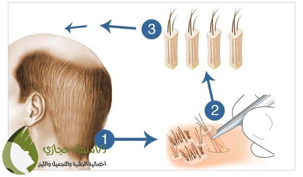 زراعة الشعر بتقنية الاقتطاف