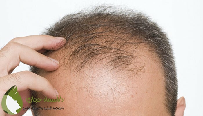 زراعة الشعر بتقنية الاقتطاف استرجع شعرك المفقود 2022