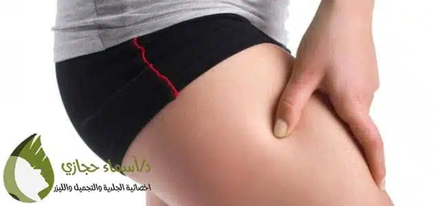 علاج السمنة الموضعية في الارداف