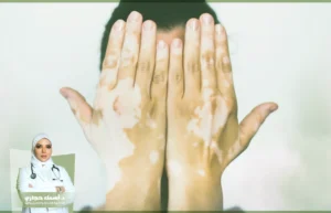 أسرع علاج للبهاق