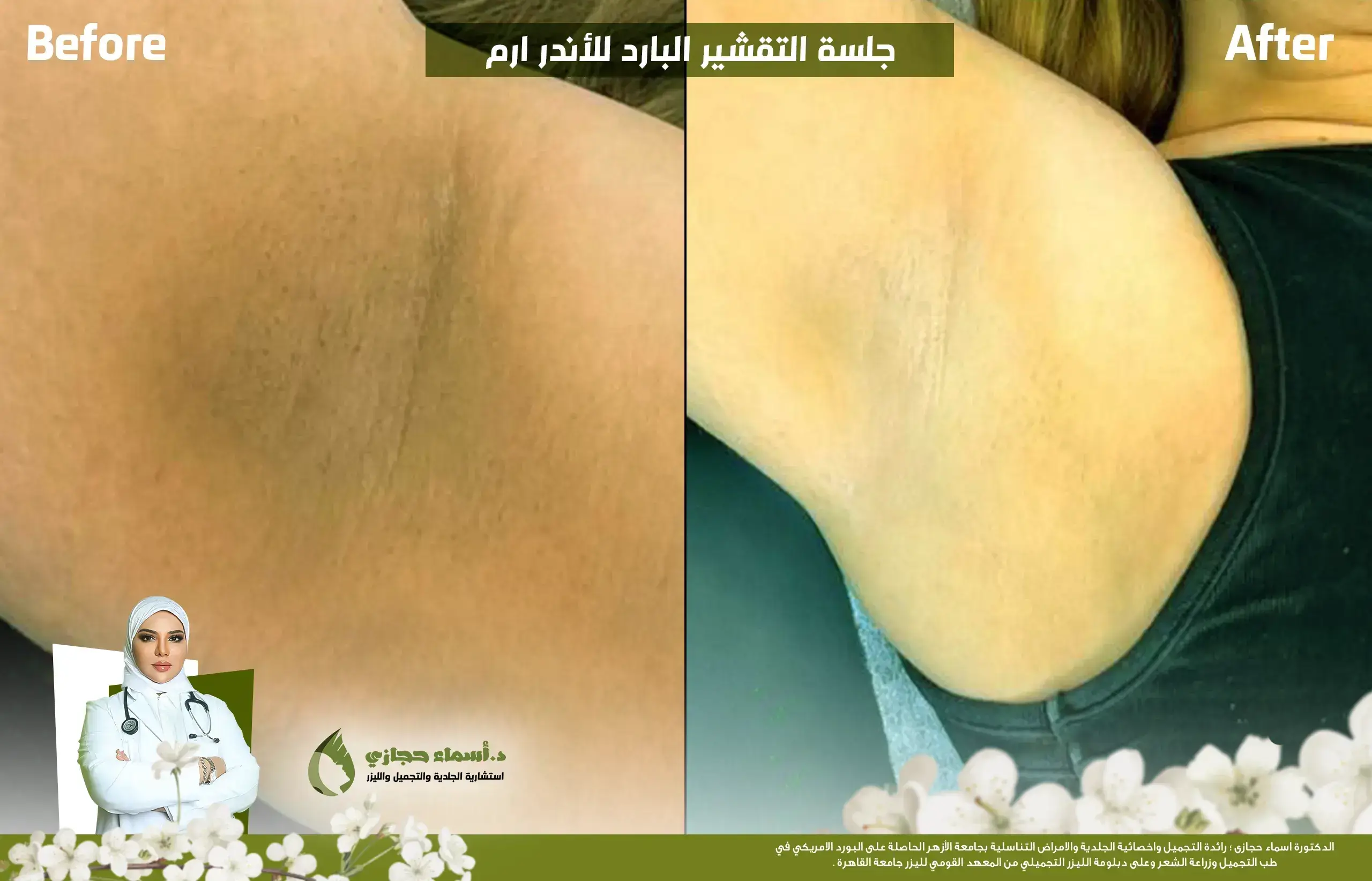 التقشير البارد للاندر ارم