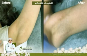 التقشير البارد للاندر ارم