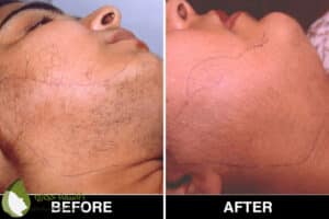 Laser Hair Removal 7 | دكتور أسماء حجازى