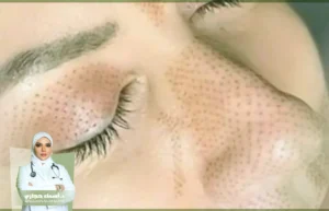 تقنية البلازماج