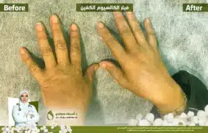 حقن فيلر الراديس