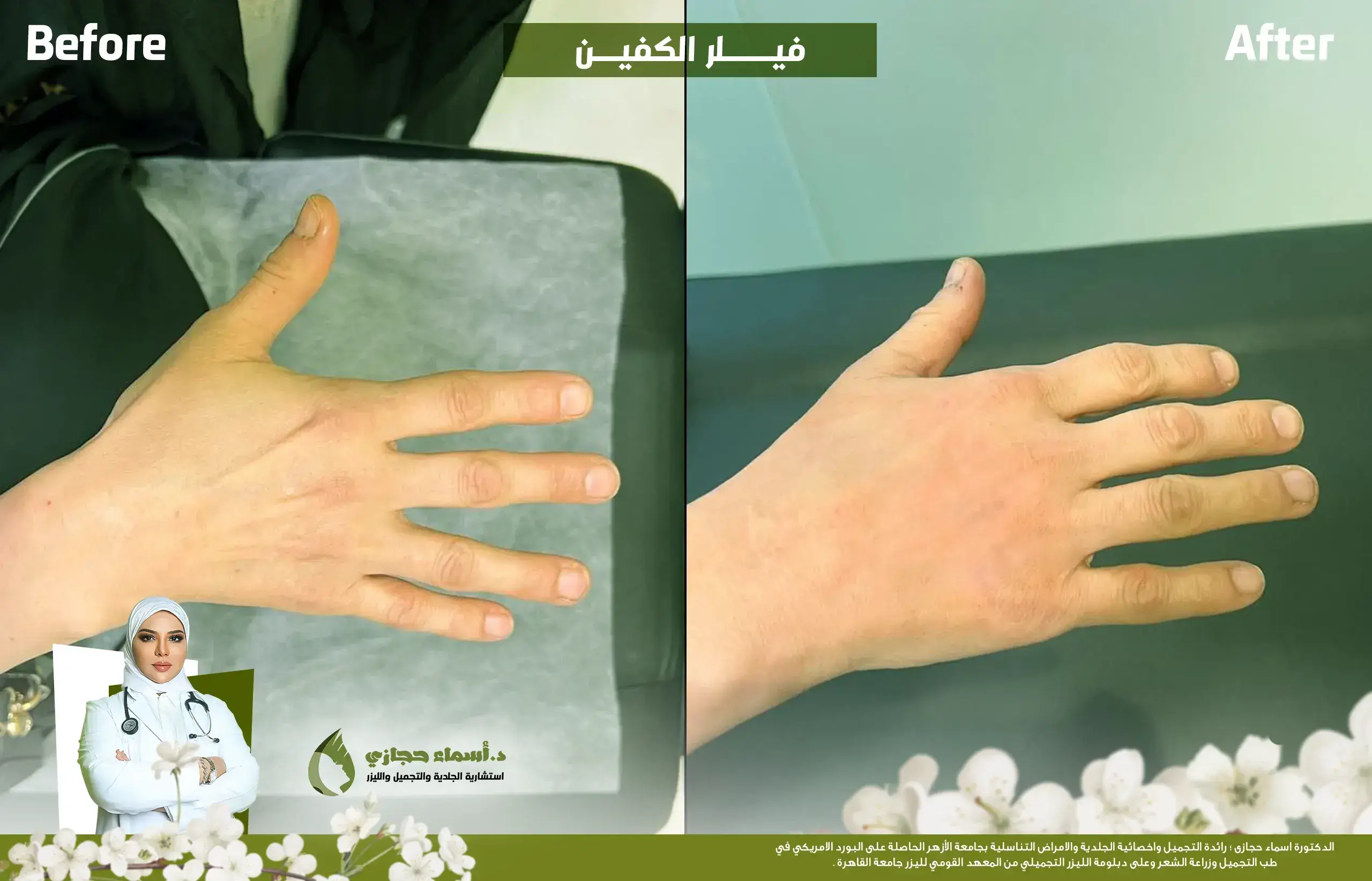 حقن فيلر الراديس