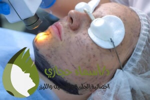جلسات النضارة بالليزر الكربوني