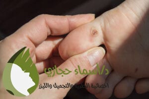 Clavus 2 | الموقع الالكتروني للدكتورة اسماء حجازي علاج عين السمكه
