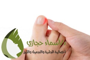 تجربتي مع عملية الظفر الغائر