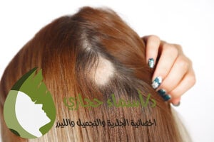 هل الثعلبة معدية