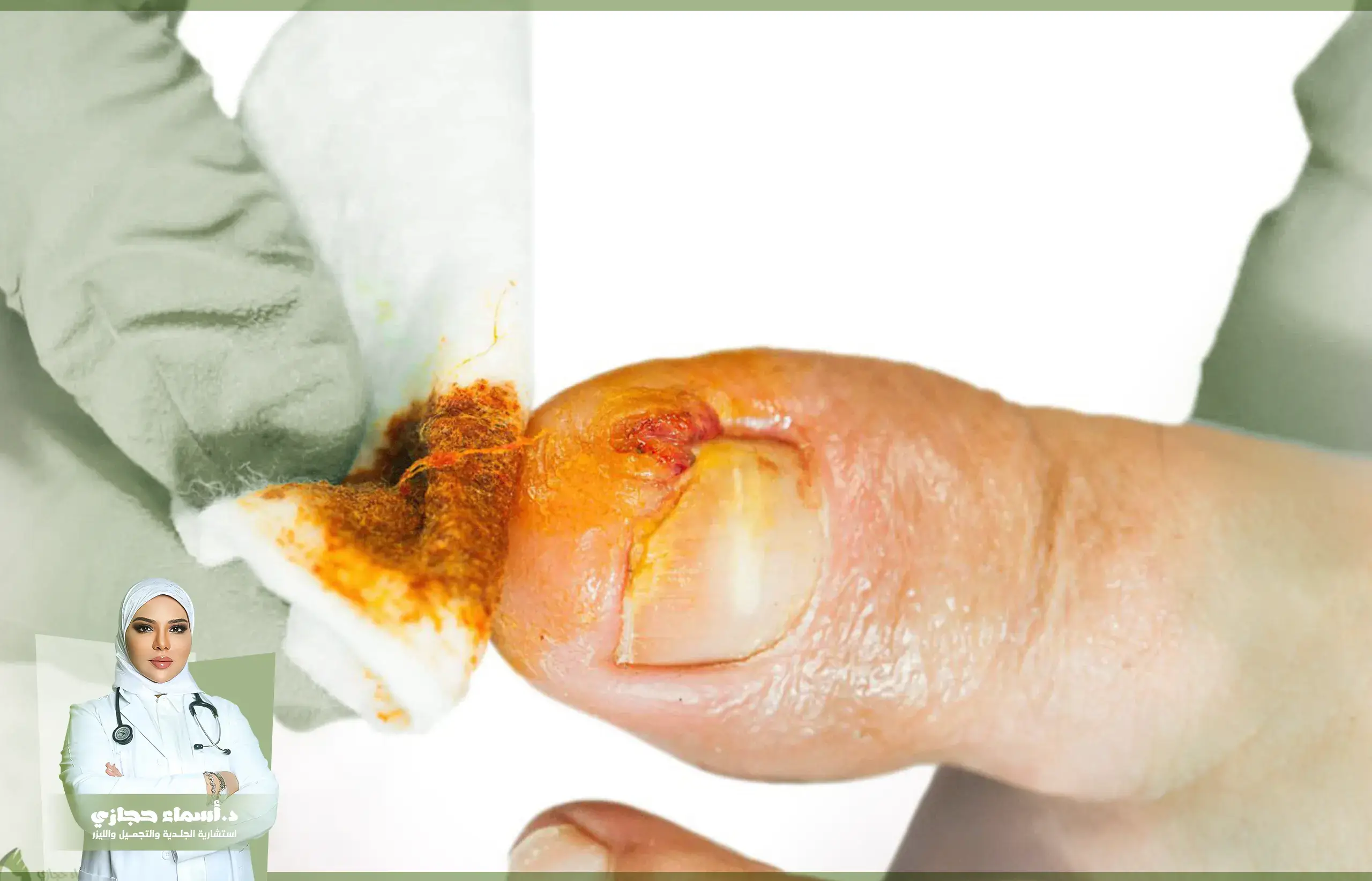 Jo 25 July 15 Artical 7 Copy | الموقع الالكتروني للدكتورة اسماء حجازي تجربتي مع عملية الظفر الغائر