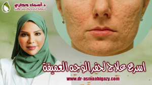 حفر الوجه نهائيا أحدث طرق علاج الندبات بنتائج سحرية و سريعة 2022 | دكتور أسماء حجازى