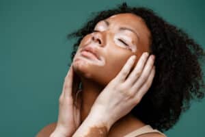 طرق علاج مرض البهاق