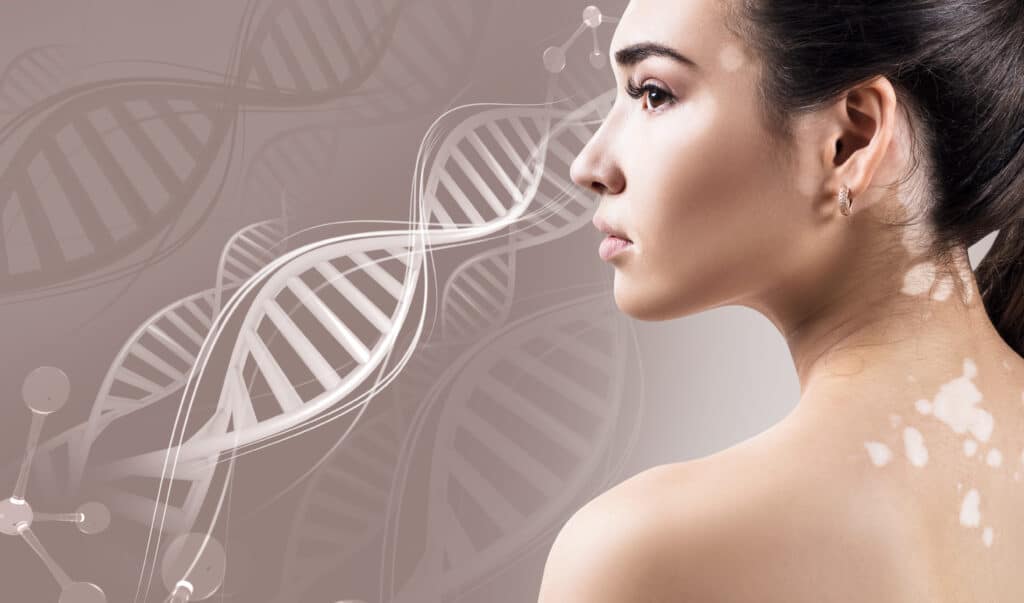 طرق علاج مرض البهاق