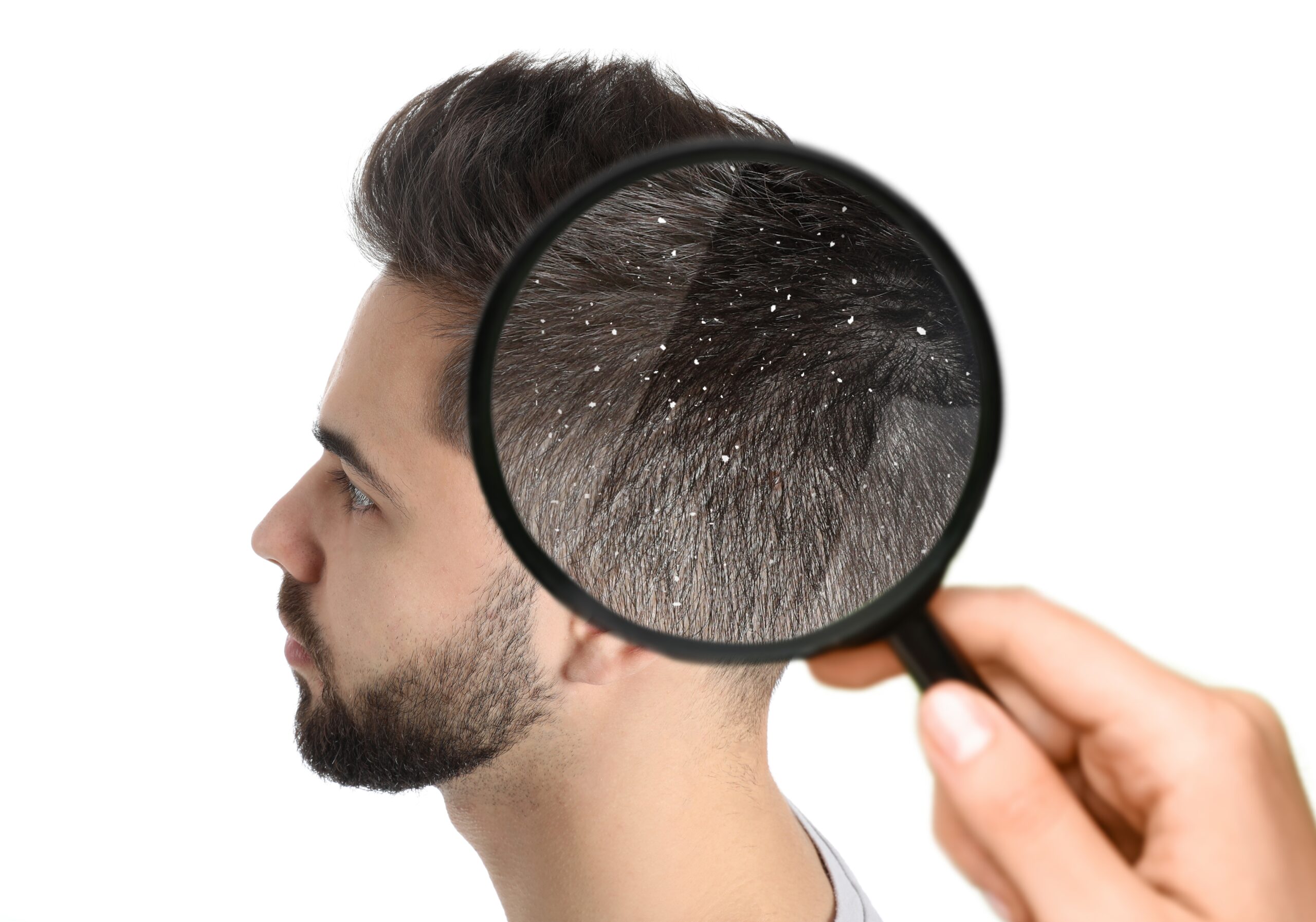 الحل النهائي لقشرة الشعر