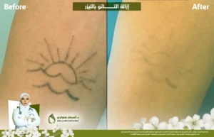 إزالة التاتو بالليزر