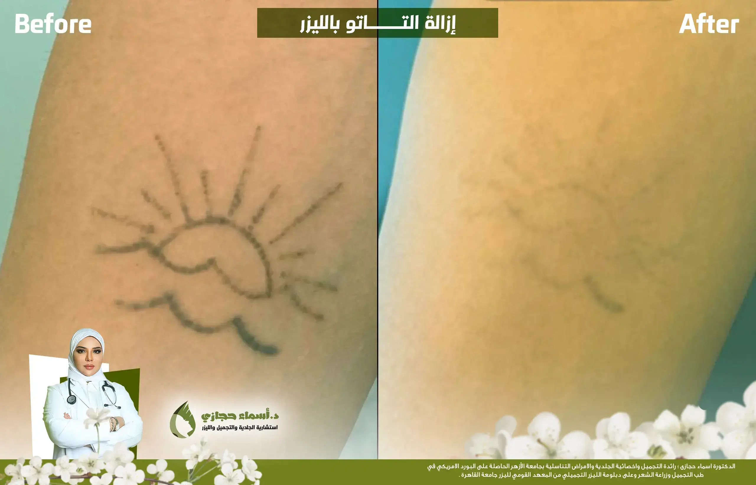 إزالة التاتو بالليزر