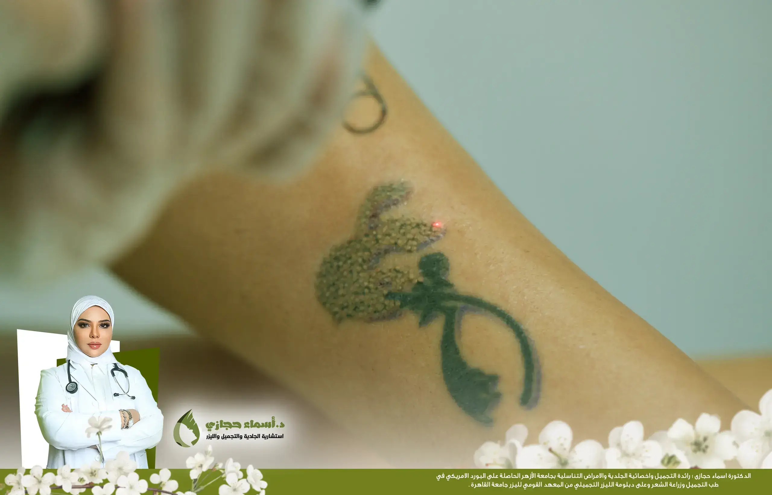 إزالة التاتو بالليزر