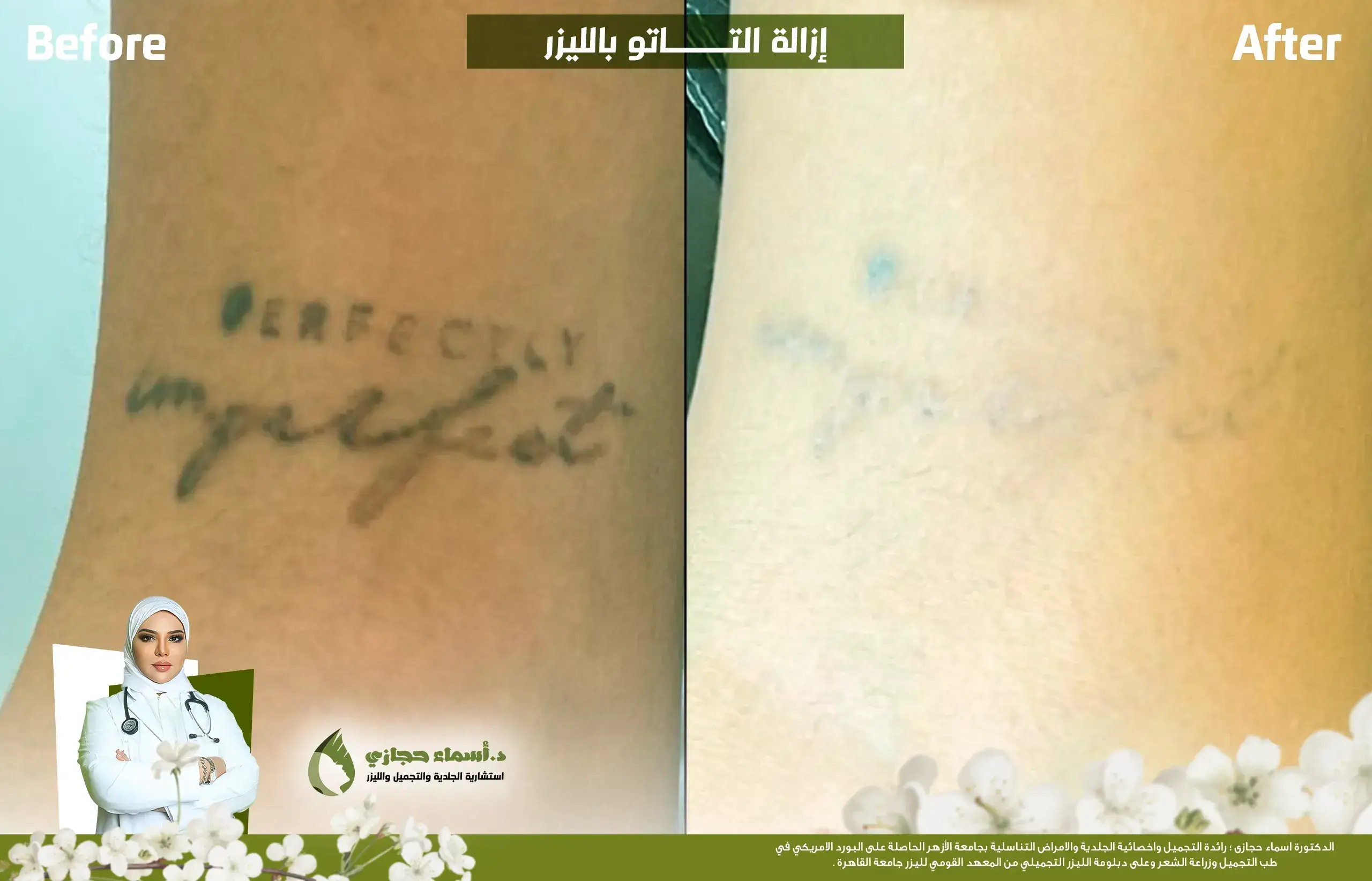 إزالة التاتو بالليزر