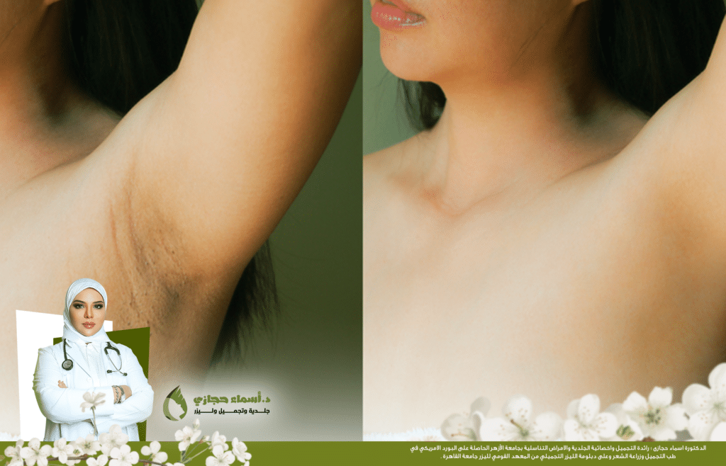 الليزر الكربوني للمنطقة الحساسة