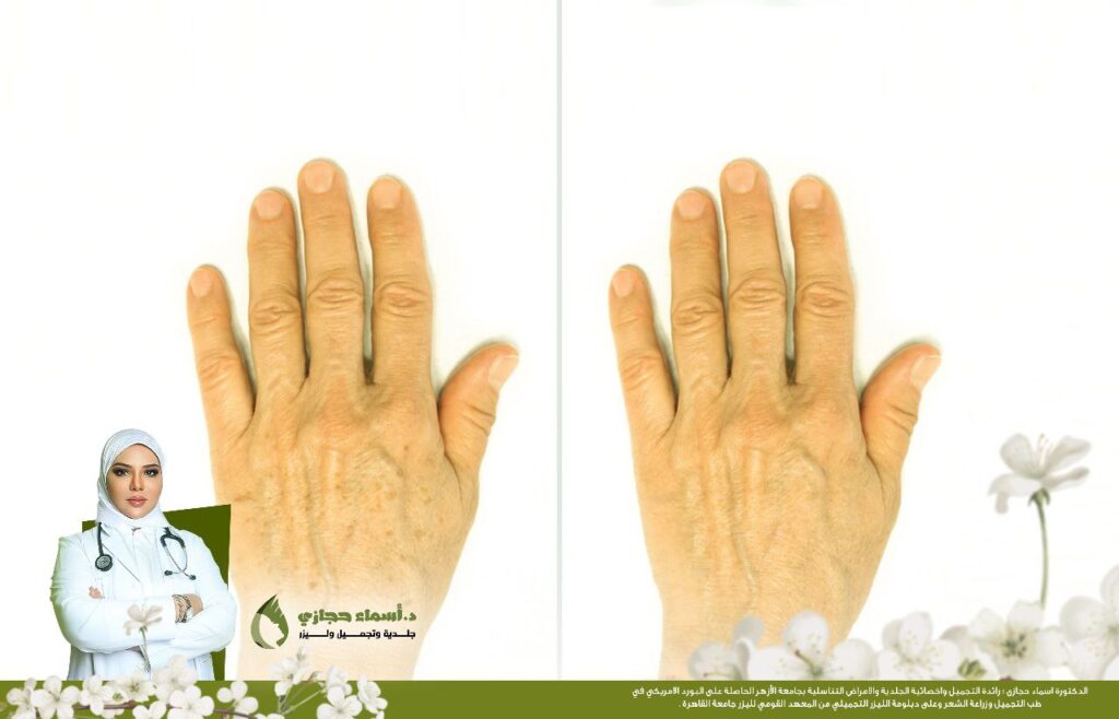 التقشير الكربوني لليدين