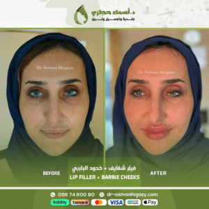 أفضل دكتورة فيلر في سوهاج