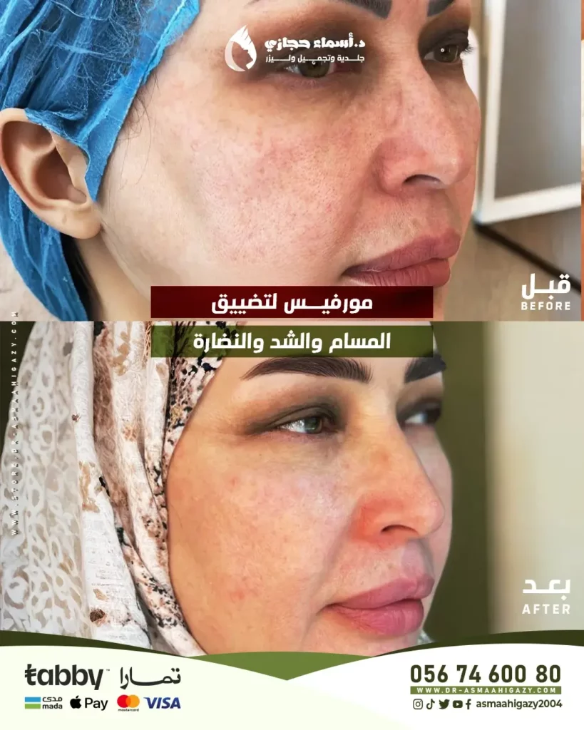 المورفيس للوجه