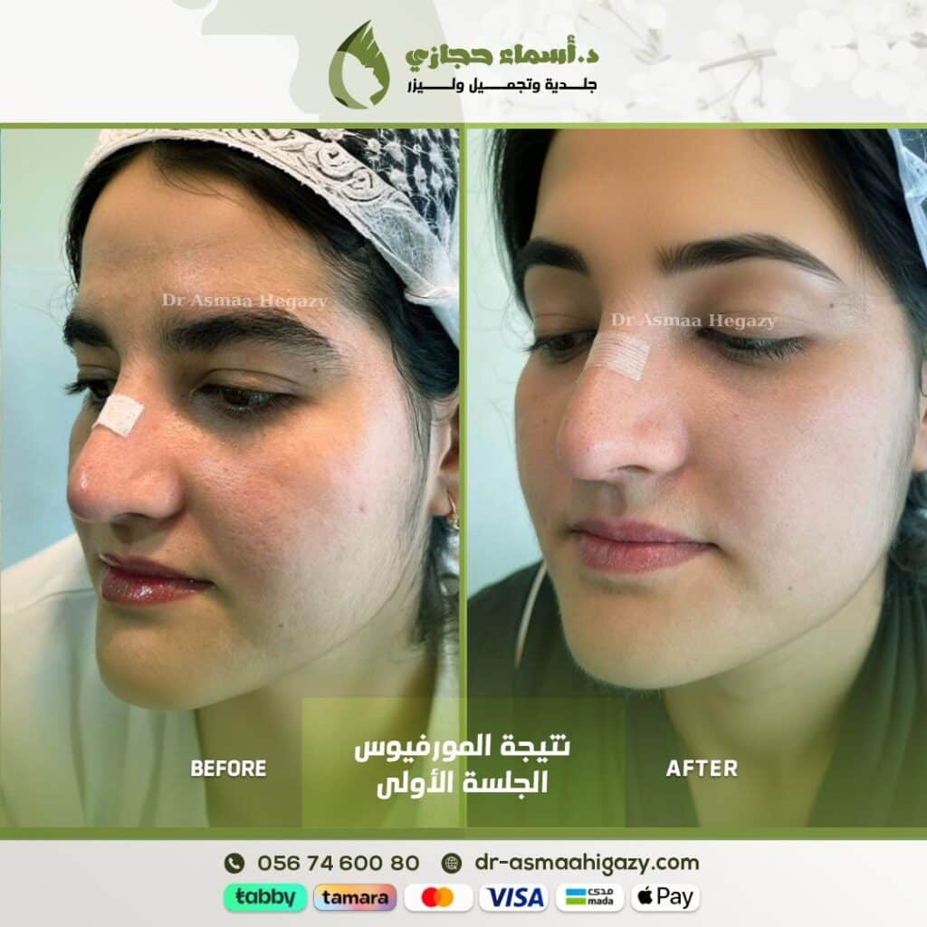 جلسة مورفيوس لعلاج وتقفيل المسامات