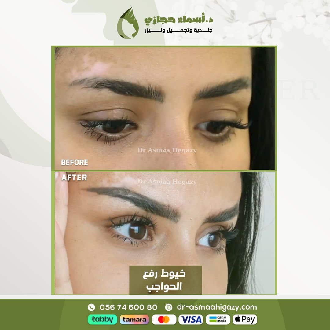 رفع الحواجب بالخيوط 3 | الموقع الالكتروني للدكتورة اسماء حجازي رفع الحواجب بالخيوط