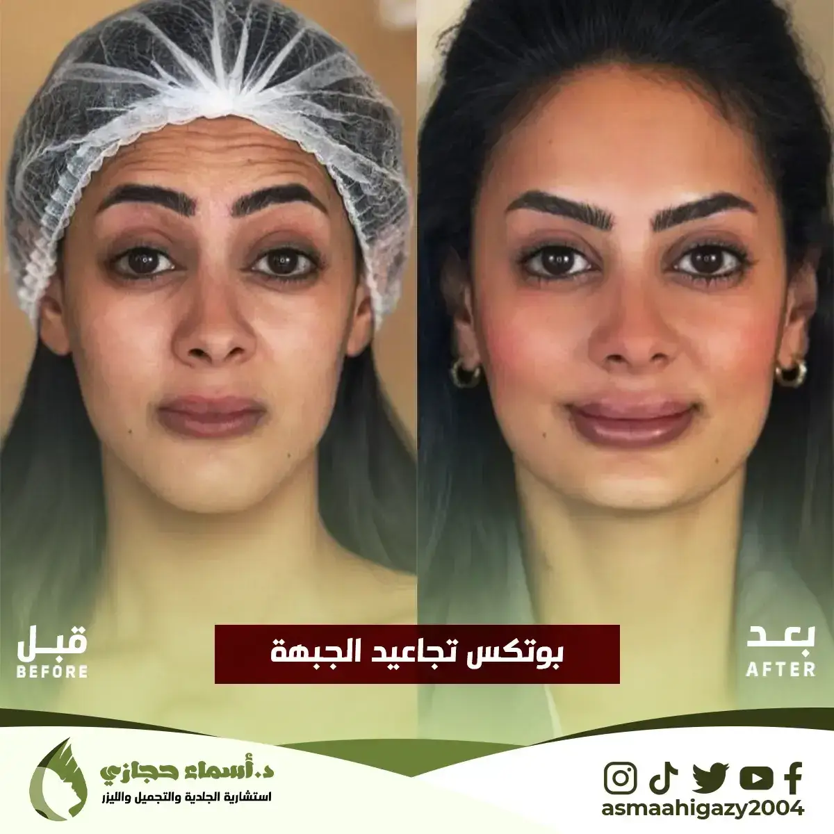 Jo-25-Apr-23-B&Amp;A-Botox-1 Copy