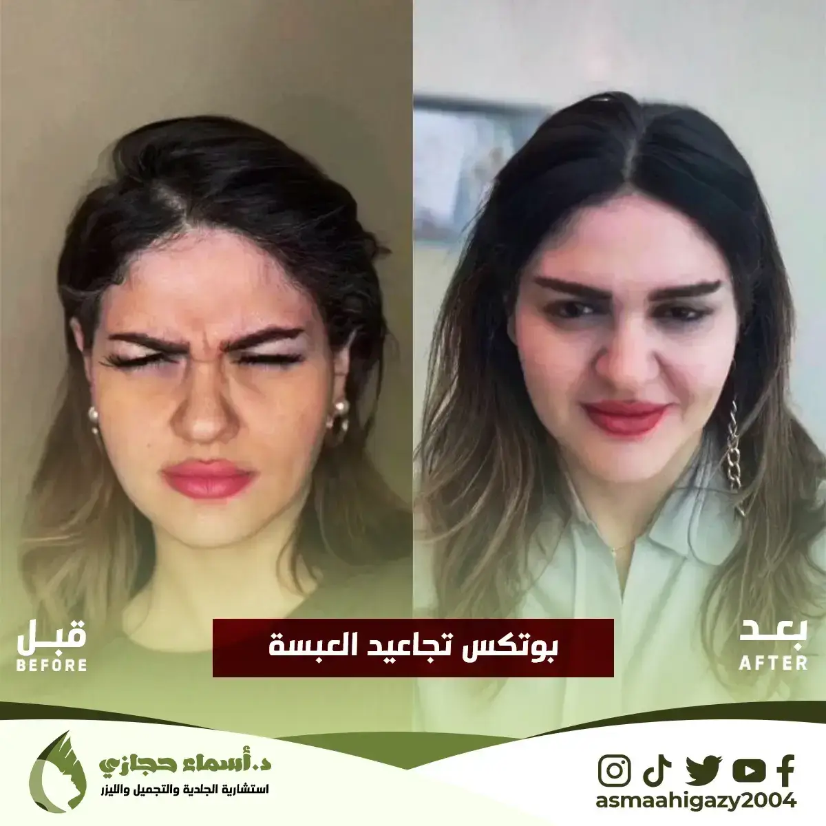 Jo-25-Apr-23-B&Amp;A-Botox-2 Copy