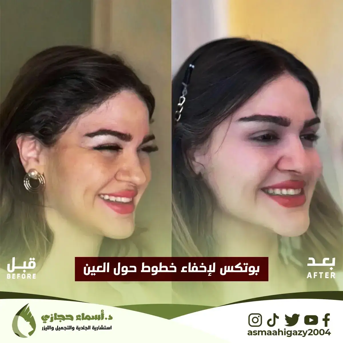 Jo-25-Apr-23-B&Amp;A-Botox-3 Copy