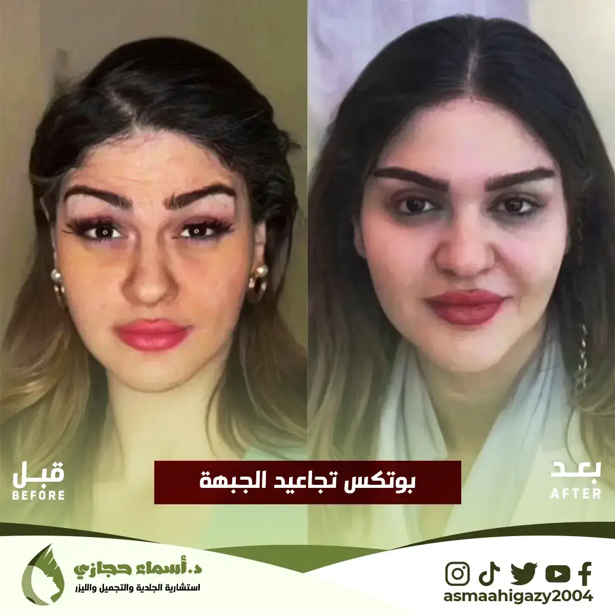 متى تبان نتيجة البوتكس