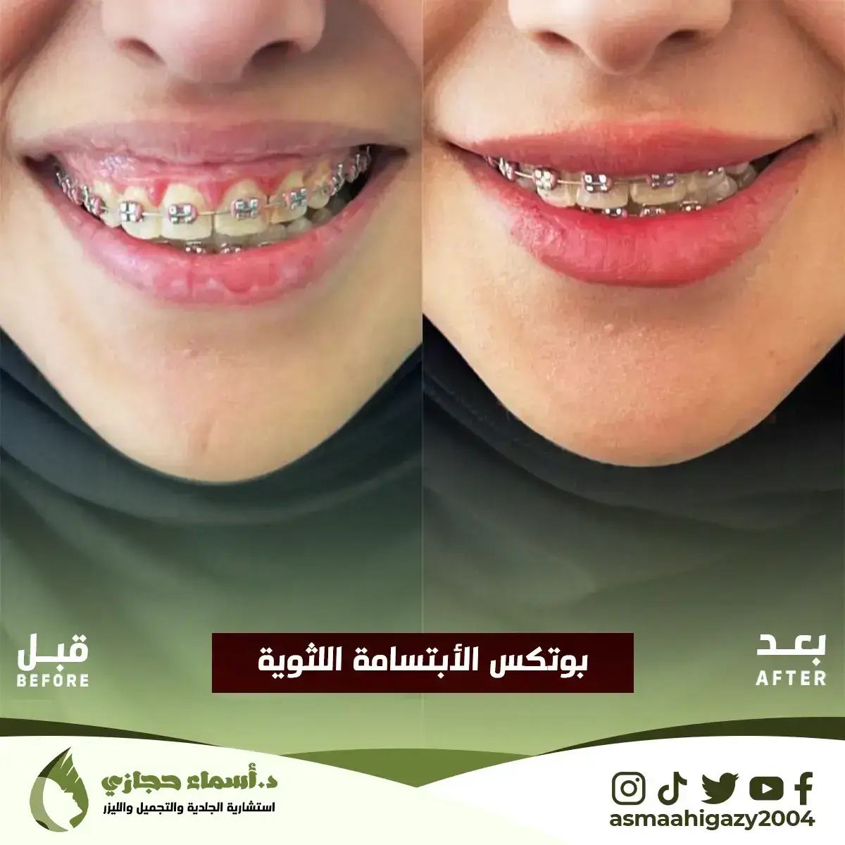 Jo-25-Apr-23-B&Amp;A-Botox-5 Copy