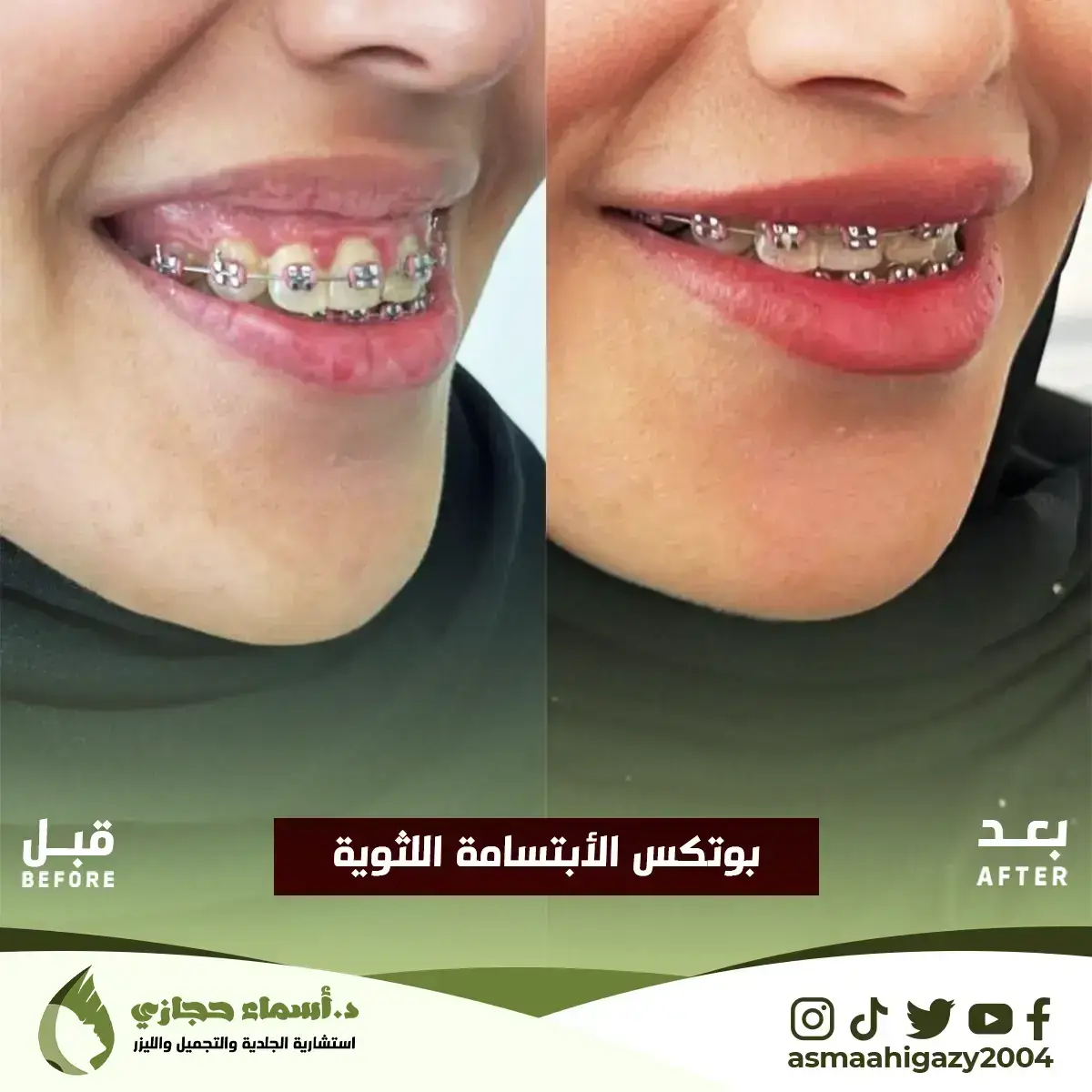 Jo-25-Apr-23-B&Amp;A-Botox-6 Copy