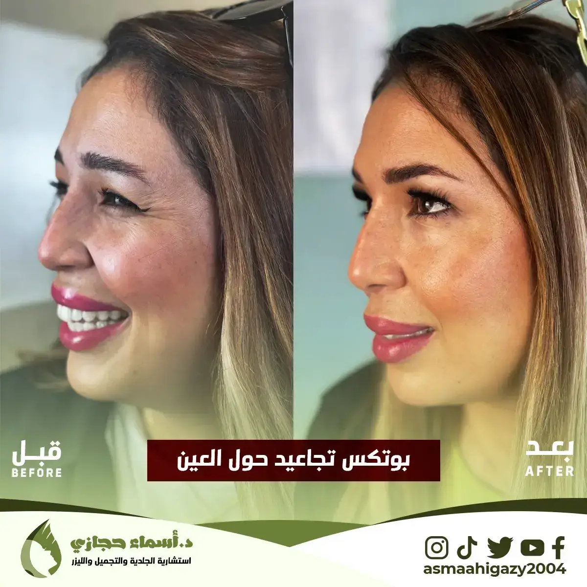 Jo-25-Apr-23-B&Amp;A-Botox-7 Copy