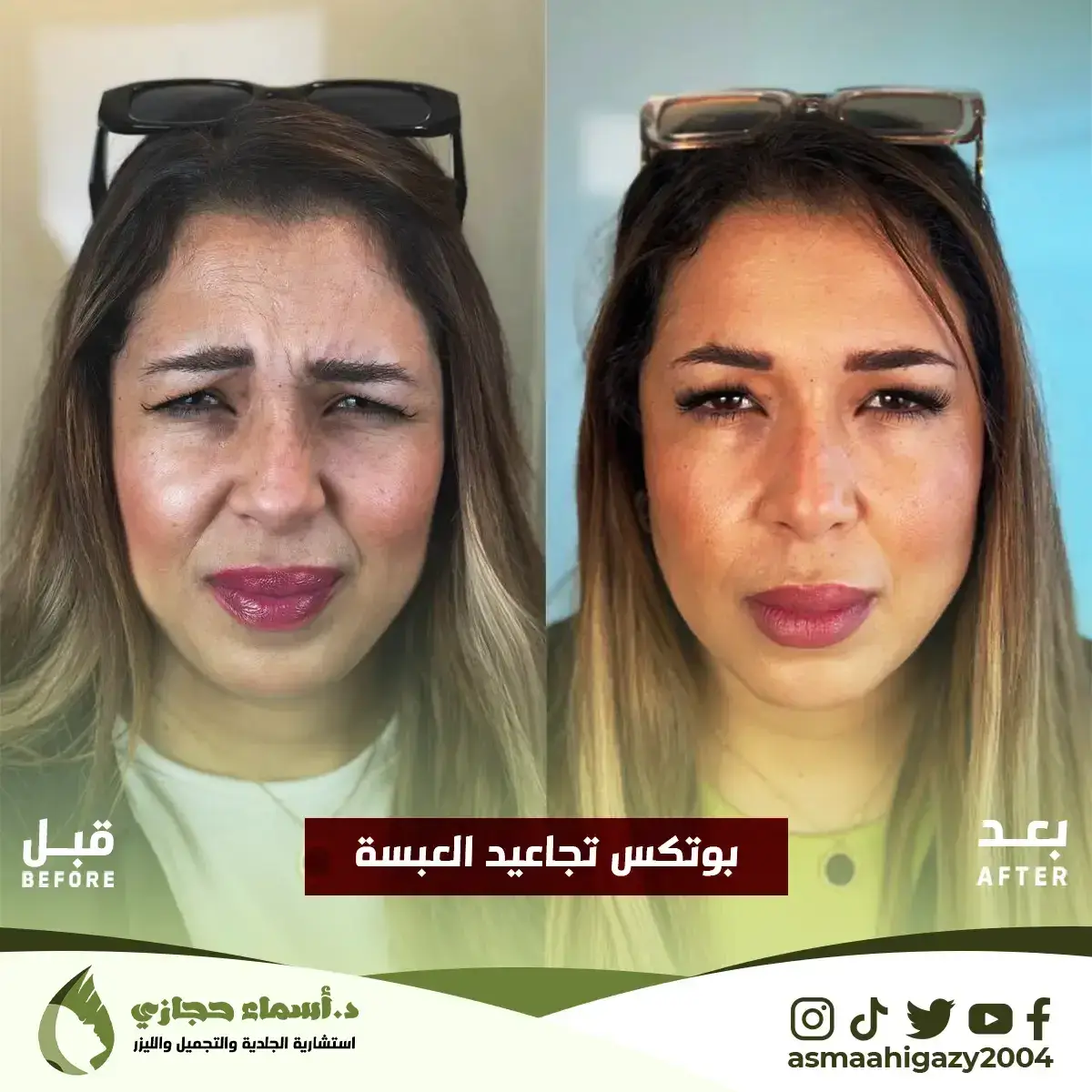 Jo-25-Apr-23-B&Amp;A-Botox-9 Copy