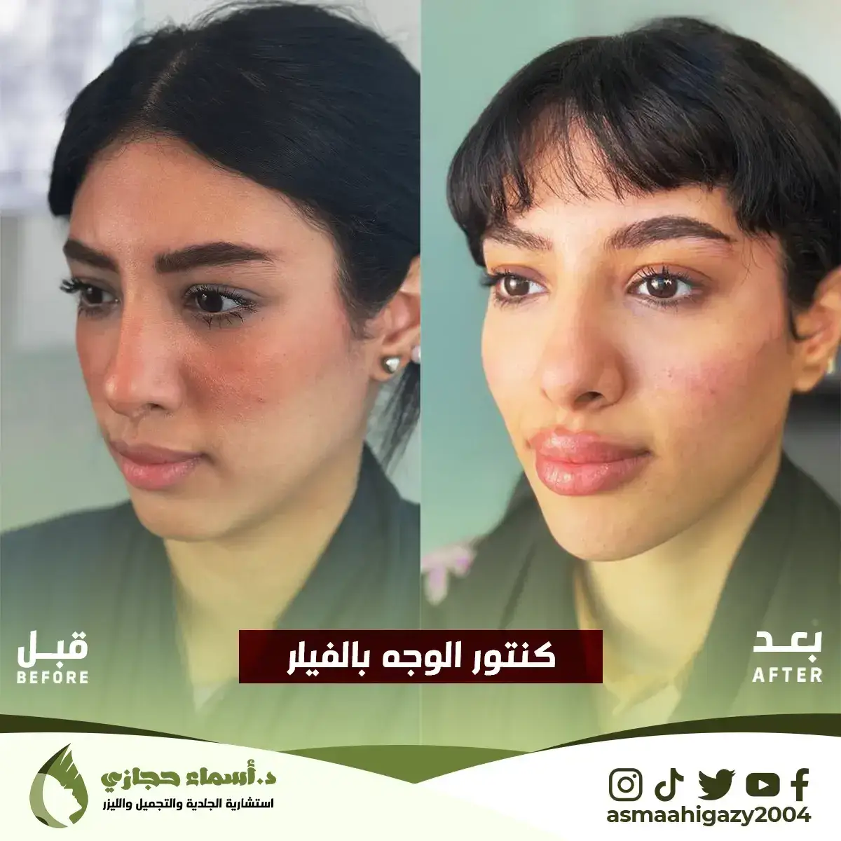 الفيلر قبل وبعد